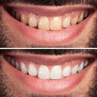 frau-zaehne-vor-und-nach-der-zahnaufhellung-gluecklich-laechelnde-frau-zahngesundheitskonzept-mundpflegekonzept (1)